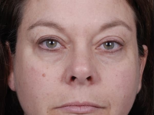 Obagi Blue Peel Radiance AFTER