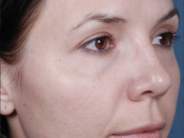 Obagi Blue Peel Radiance Post Treatment