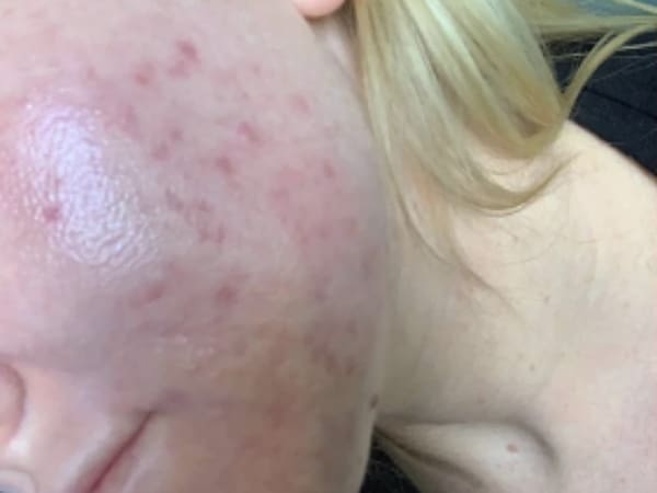 Obagi Blue Peel Radiance Acne Treatment Before