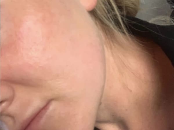 Obagi Blue Peel Radiance Acne Treatment After